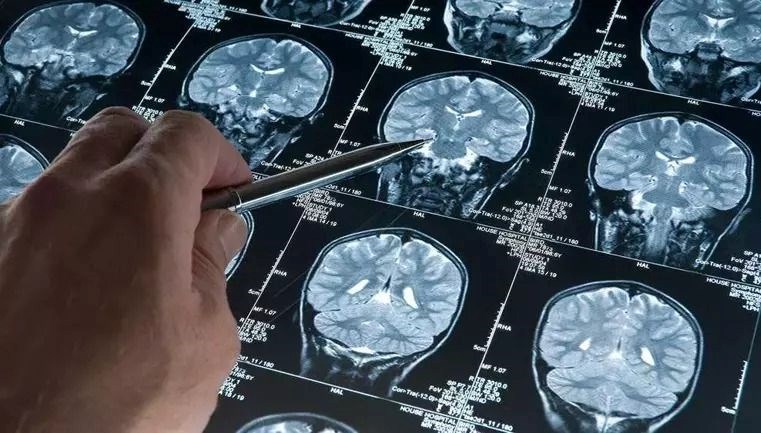 Bilim dünyası şokta: En genç Alzheimer vakası teşhis edildi