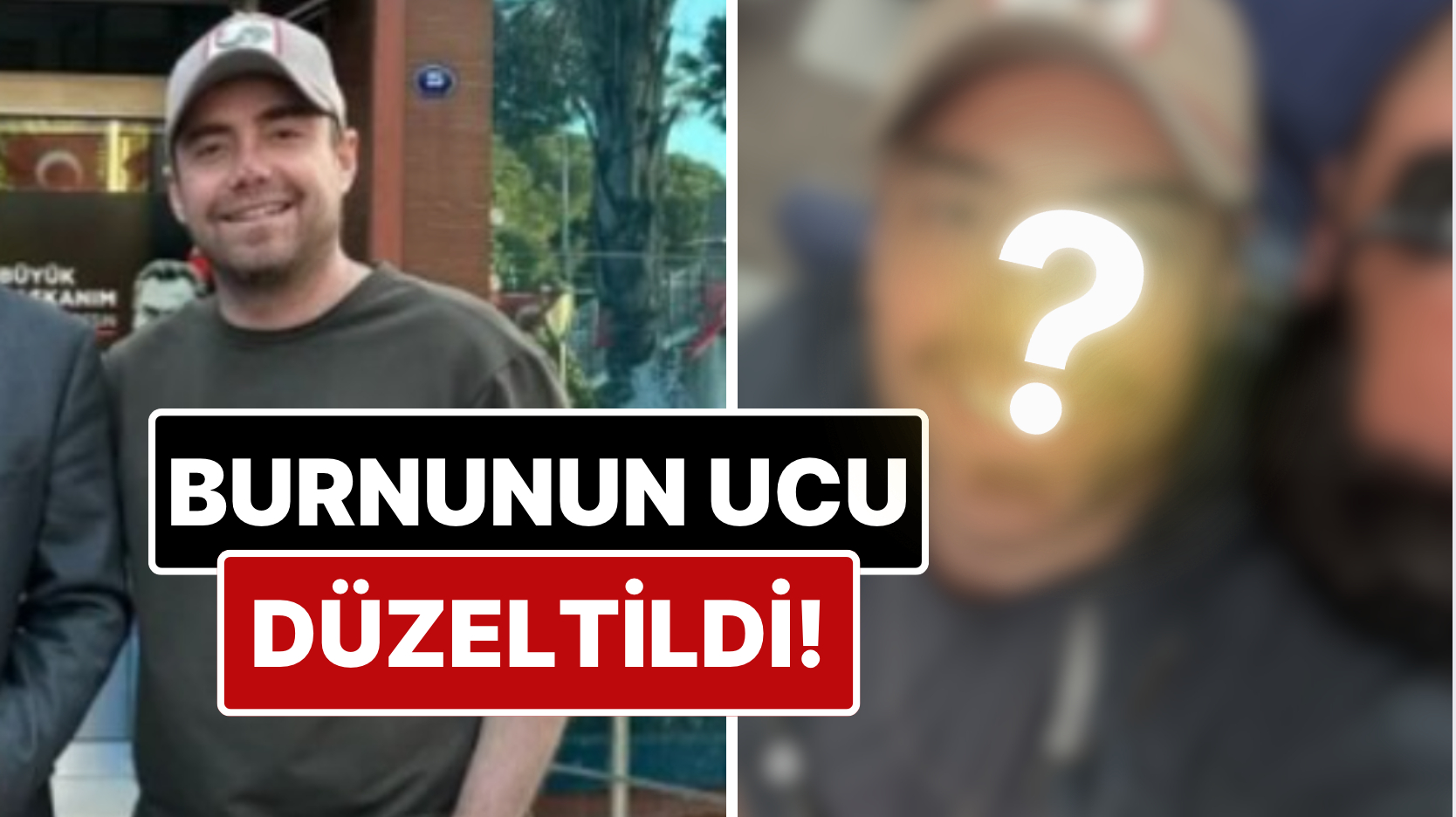11 Kez Ameliyat Geçiren Murat Dalkılıç'ın Burnunun Ucu Estetik Müdahalelerle Düzeltildi!